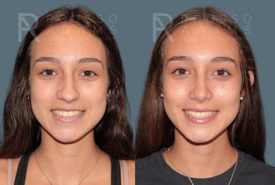 Rhinoplasty <span class=small>By Dr. Daniel Rousso</span> Before & After Gallery - Patient 158946 - Image 2