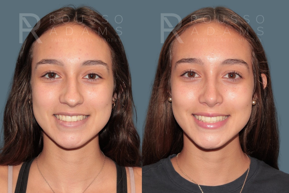 Rhinoplasty <span class=small>By Dr. Daniel Rousso</span> Before & After Gallery - Patient 158946 - Image 2