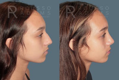 Rhinoplasty <span class=small>By Dr. Daniel Rousso</span> Before & After Gallery - Patient 158946 - Image 1