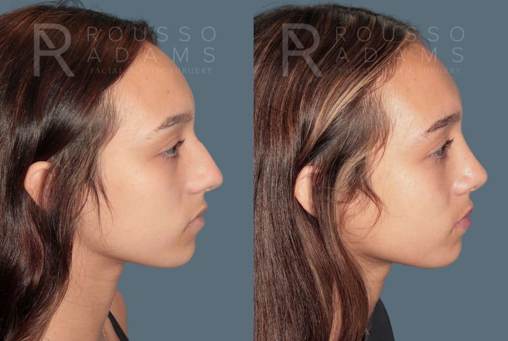 Rhinoplasty <span class=small>By Dr. Daniel Rousso</span> Before & After Gallery - Patient 158946 - Image 1