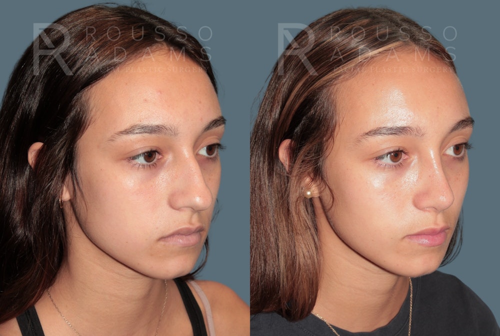 Rhinoplasty <span class=small>By Dr. Daniel Rousso</span> Before & After Gallery - Patient 158946 - Image 3