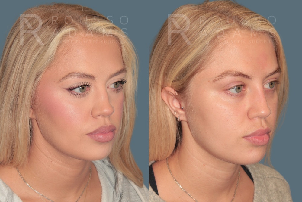 Rhinoplasty <span class=small>By Dr. Daniel Rousso</span> Before & After Gallery - Patient 100681 - Image 2
