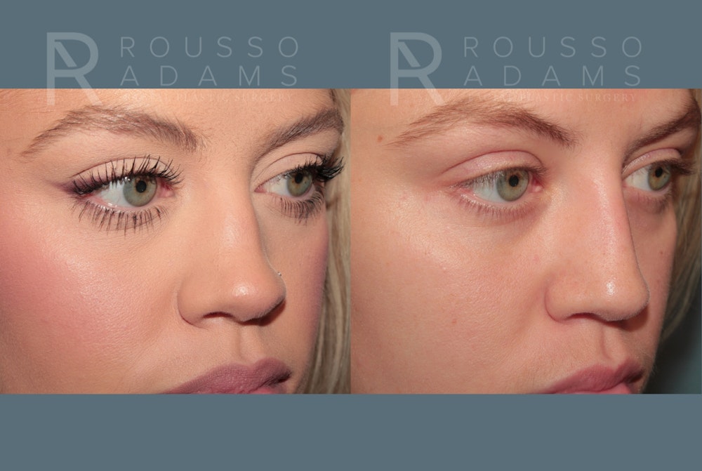 Rhinoplasty <span class=small>By Dr. Daniel Rousso</span> Before & After Gallery - Patient 100681 - Image 3