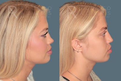 Rhinoplasty <span class=small>By Dr. Daniel Rousso</span> Before & After Gallery - Patient 100681 - Image 1