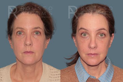 Skin Rejuvenation<span class=small>By Dr. Austin Adams</span> Before & After Gallery - Patient 249291 - Image 4