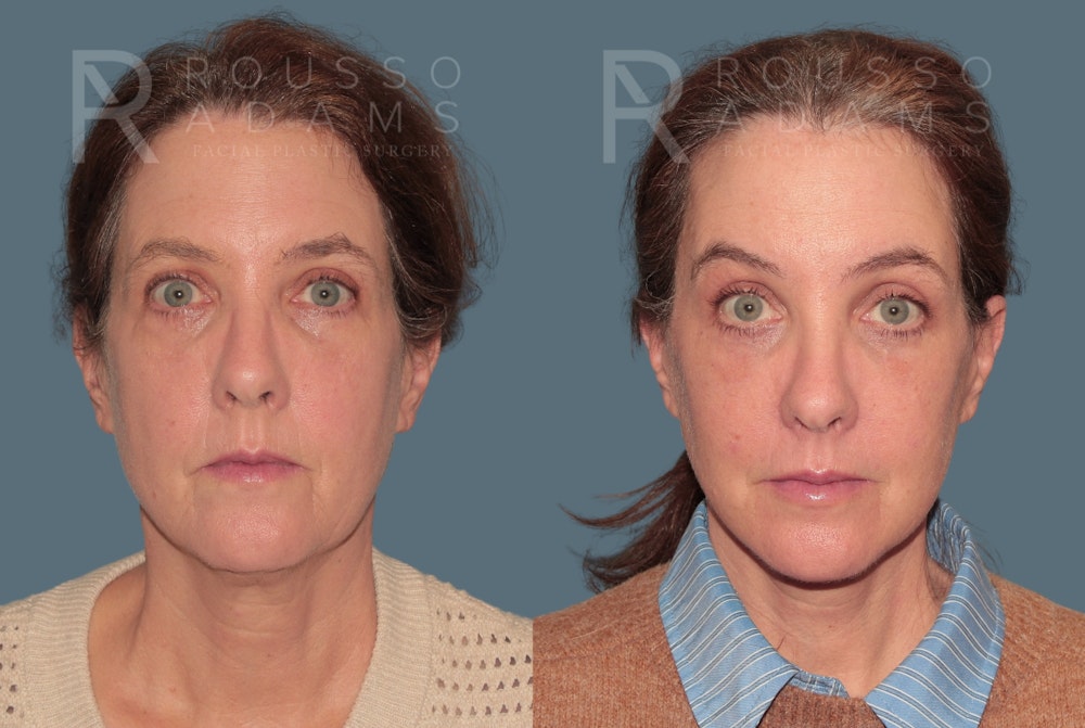 Skin Rejuvenation<span class=small>By Dr. Austin Adams</span> Before & After Gallery - Patient 249291 - Image 4