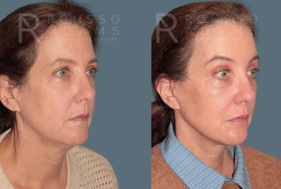 Deep Plane Facelift <span class=small>By Dr. Austin Adams</span> Before & After Gallery - Patient 105508 - Image 1