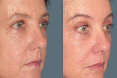 Skin Rejuvenation<span class=small>By Dr. Austin Adams</span> Before & After Gallery - Patient 249291 - Image 1