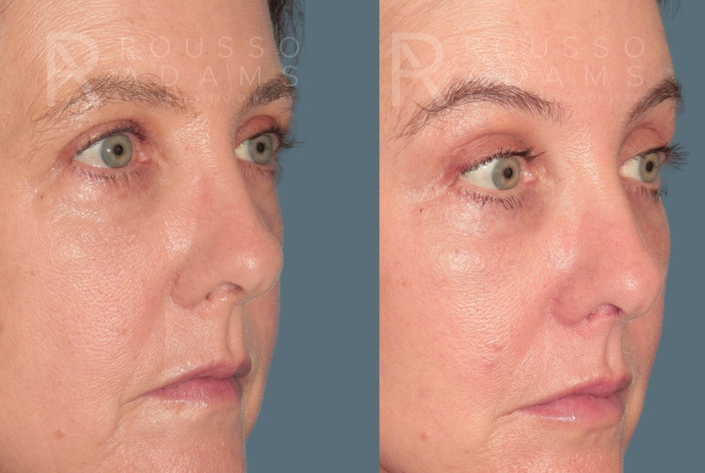 Deep Plane Facelift <span class=small>By Dr. Austin Adams</span> Before & After Gallery - Patient 105508 - Image 4