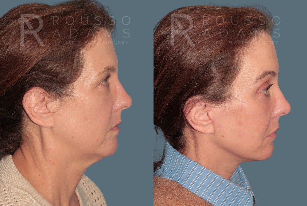 Skin Rejuvenation<span class=small>By Dr. Austin Adams</span> Before & After Gallery - Patient 249291 - Image 3