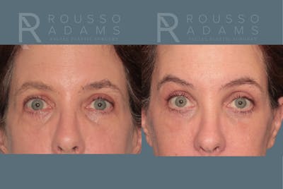 Blepharoplasty<span class=small>By Dr. Austin Adams</span> Before & After Gallery - Patient 242551 - Image 1