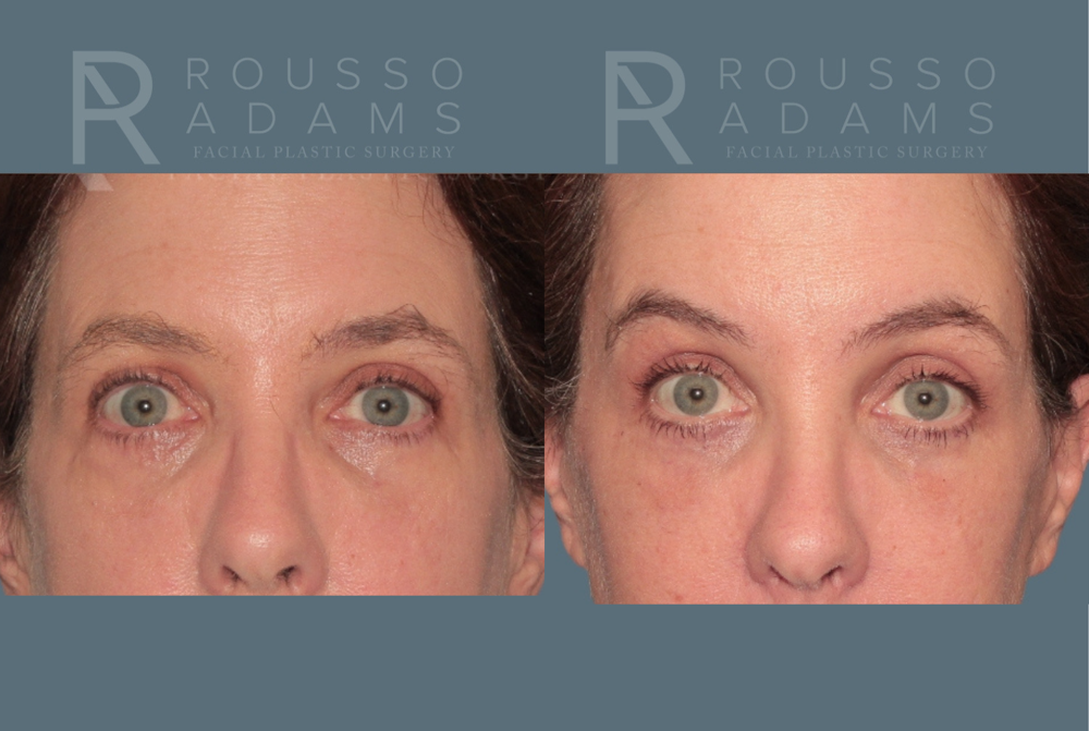 Blepharoplasty<span class=small>By Dr. Austin Adams</span> Before & After Gallery - Patient 242551 - Image 1