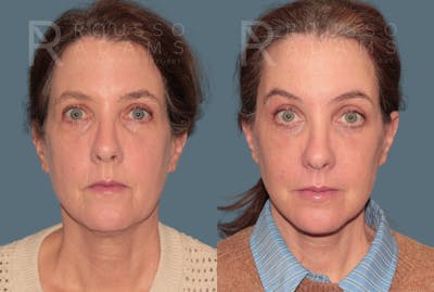 Deep Plane Facelift <span class=small>By Dr. Austin Adams</span> Before & After Gallery - Patient 105508 - Image 2