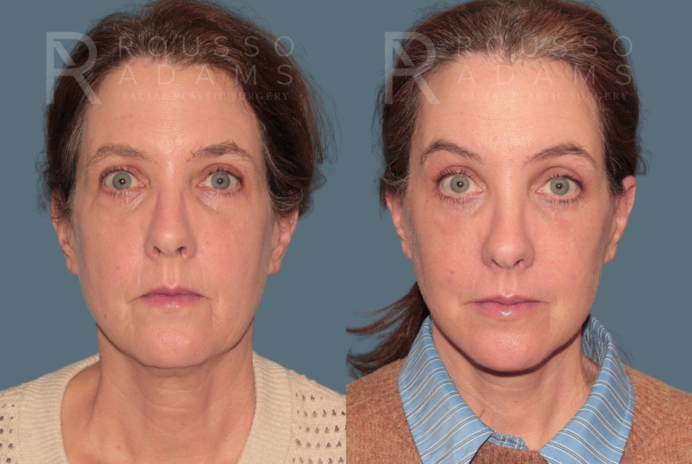 Deep Plane Facelift <span class=small>By Dr. Austin Adams</span> Before & After Gallery - Patient 105508 - Image 2