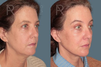 Deep Plane Facelift <span class=small>By Dr. Austin Adams</span> Before & After Gallery - Patient 105508 - Image 1