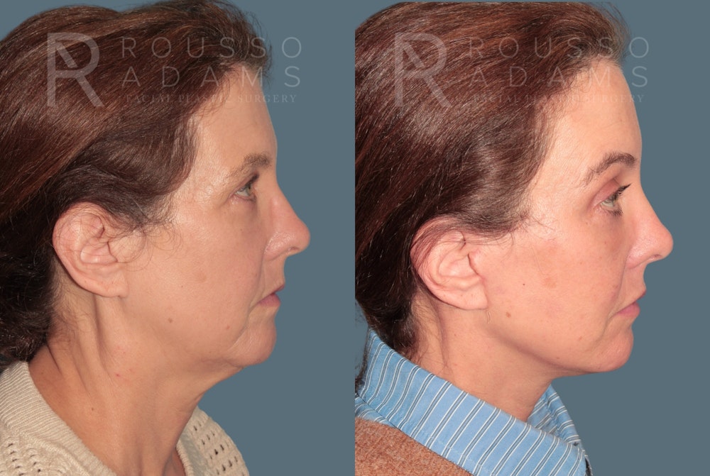 Deep Plane Facelift <span class=small>By Dr. Austin Adams</span> Before & After Gallery - Patient 105508 - Image 3