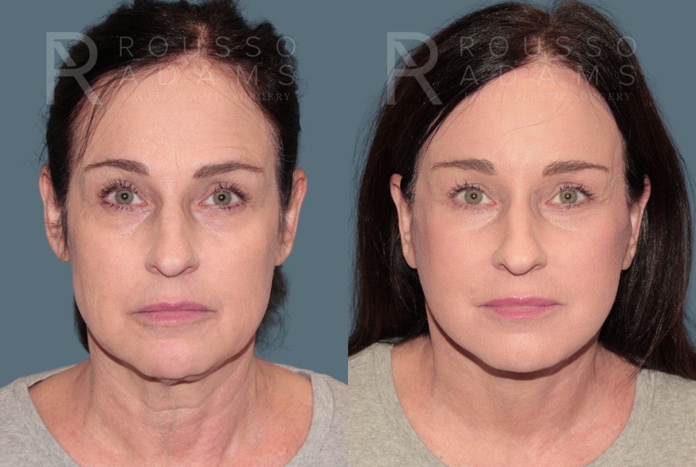 Deep Plane Facelift <span class=small>By Dr. Austin Adams</span> Before & After Gallery - Patient 157261 - Image 2