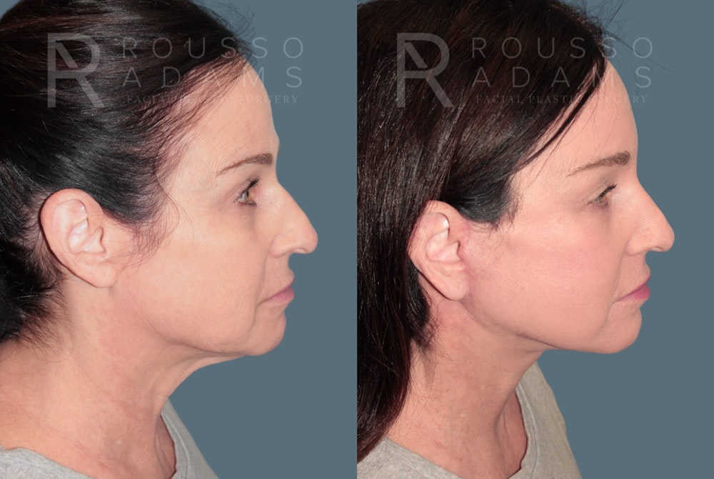 Deep Plane Facelift <span class=small>By Dr. Austin Adams</span> Before & After Gallery - Patient 157261 - Image 3