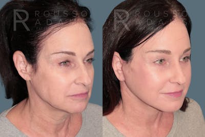 Deep Plane Facelift <span class=small>By Dr. Austin Adams</span> Before & After Gallery - Patient 157261 - Image 1