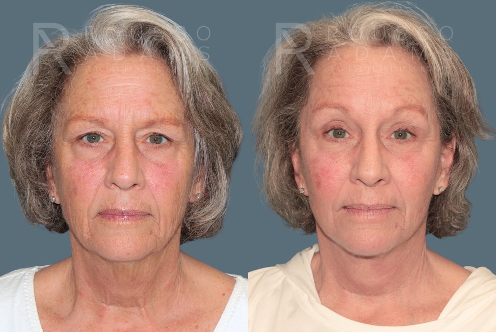 Deep Plane Facelift <span class=small>By Dr. Austin Adams</span> Before & After Gallery - Patient 299132 - Image 2