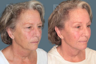 Deep Plane Facelift <span class=small>By Dr. Austin Adams</span> Before & After Gallery - Patient 299132 - Image 1