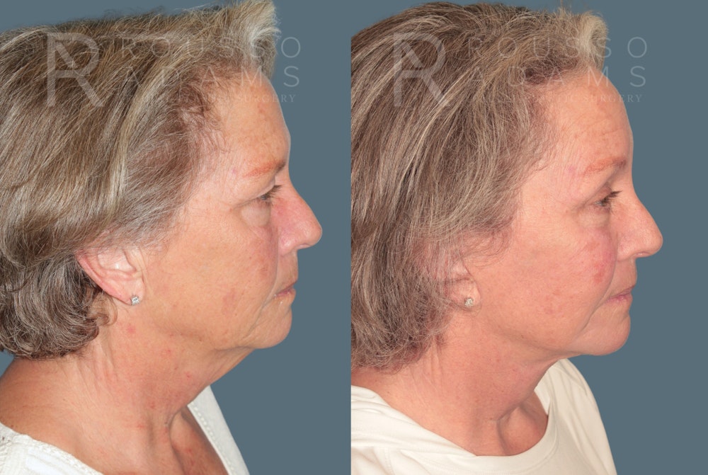 Deep Plane Facelift <span class=small>By Dr. Austin Adams</span> Before & After Gallery - Patient 299132 - Image 3