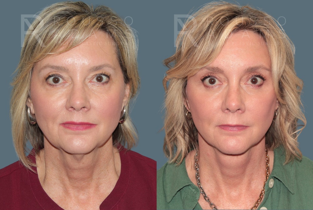 Deep Plane Facelift <span class=small>By Dr. Austin Adams</span> Before & After Gallery - Patient 217083 - Image 2