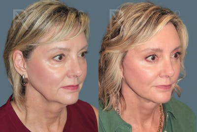 Deep Plane Facelift <span class=small>By Dr. Austin Adams</span> Before & After Gallery - Patient 217083 - Image 1