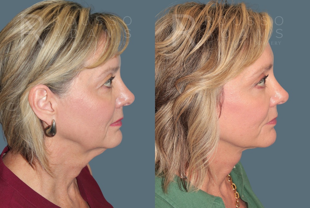 Deep Plane Facelift <span class=small>By Dr. Austin Adams</span> Before & After Gallery - Patient 217083 - Image 3