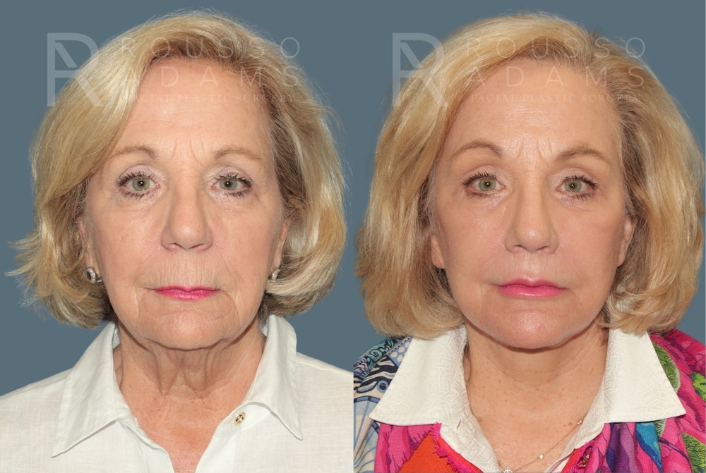 Deep Plane Facelift <span class=small>By Dr. Austin Adams</span> Before & After Gallery - Patient 284188 - Image 2