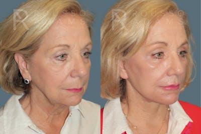 Deep Plane Facelift <span class=small>By Dr. Austin Adams</span> Before & After Gallery - Patient 284188 - Image 1