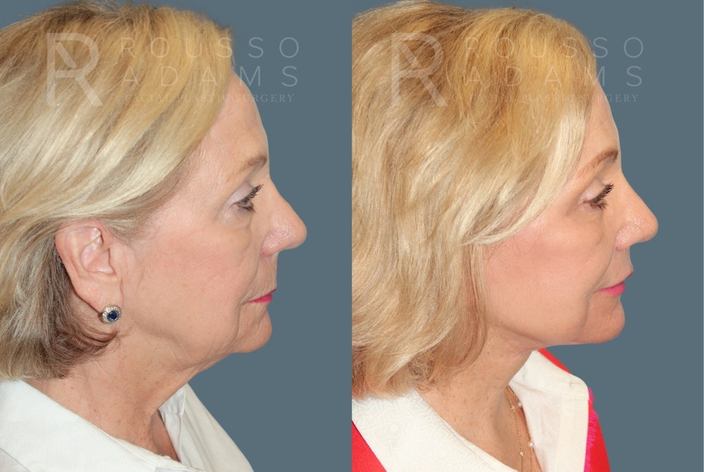 Deep Plane Facelift <span class=small>By Dr. Austin Adams</span> Before & After Gallery - Patient 284188 - Image 3