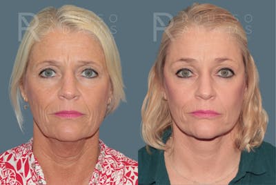 Deep Plane Facelift <span class=small>By Dr. Austin Adams</span> Before & After Gallery - Patient 211211 - Image 2