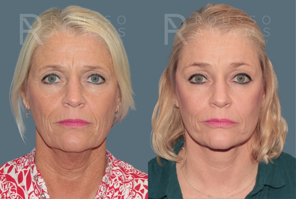 Deep Plane Facelift <span class=small>By Dr. Austin Adams</span> Before & After Gallery - Patient 211211 - Image 2