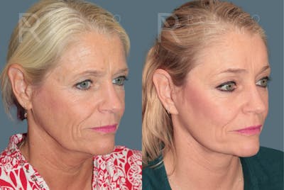 Deep Plane Facelift <span class=small>By Dr. Austin Adams</span> Before & After Gallery - Patient 211211 - Image 1