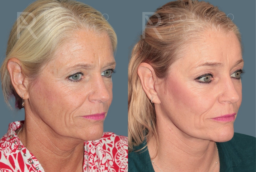 Deep Plane Facelift <span class=small>By Dr. Austin Adams</span> Before & After Gallery - Patient 211211 - Image 1