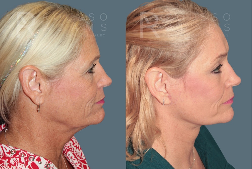 Deep Plane Facelift <span class=small>By Dr. Austin Adams</span> Before & After Gallery - Patient 211211 - Image 3