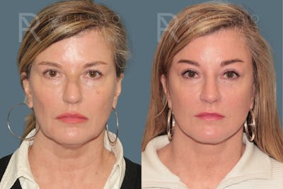 Deep Plane Facelift <span class=small>By Dr. Austin Adams</span> Before & After Gallery - Patient 367347 - Image 2