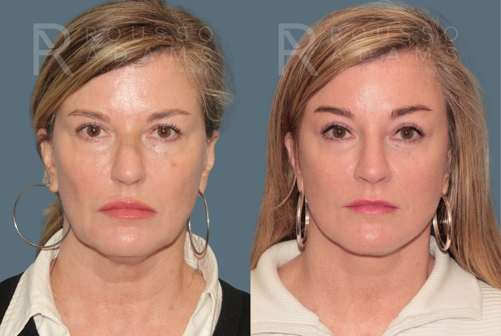 Deep Plane Facelift <span class=small>By Dr. Austin Adams</span> Before & After Gallery - Patient 367347 - Image 2
