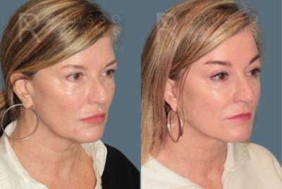 Deep Plane Facelift <span class=small>By Dr. Austin Adams</span> Before & After Gallery - Patient 367347 - Image 1