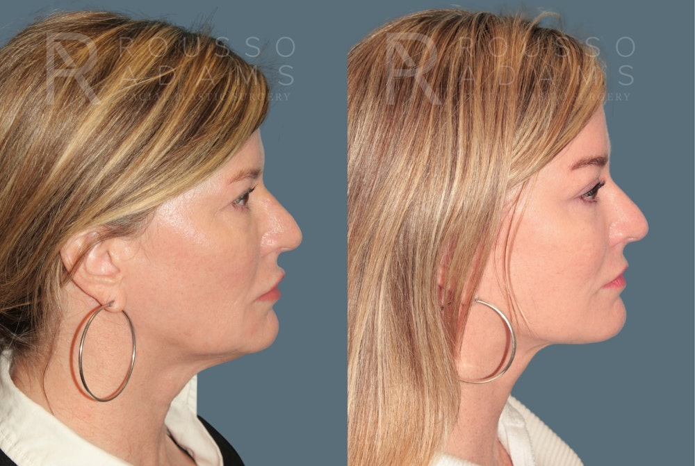 Deep Plane Facelift <span class=small>By Dr. Austin Adams</span> Before & After Gallery - Patient 367347 - Image 3