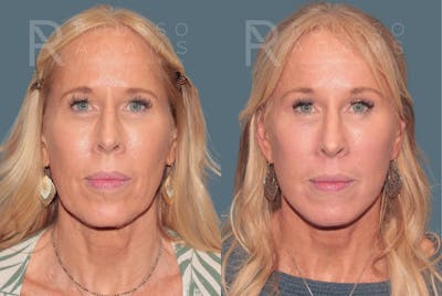 Deep Plane Facelift <span class=small>By Dr. Austin Adams</span> Before & After Gallery - Patient 388371 - Image 2