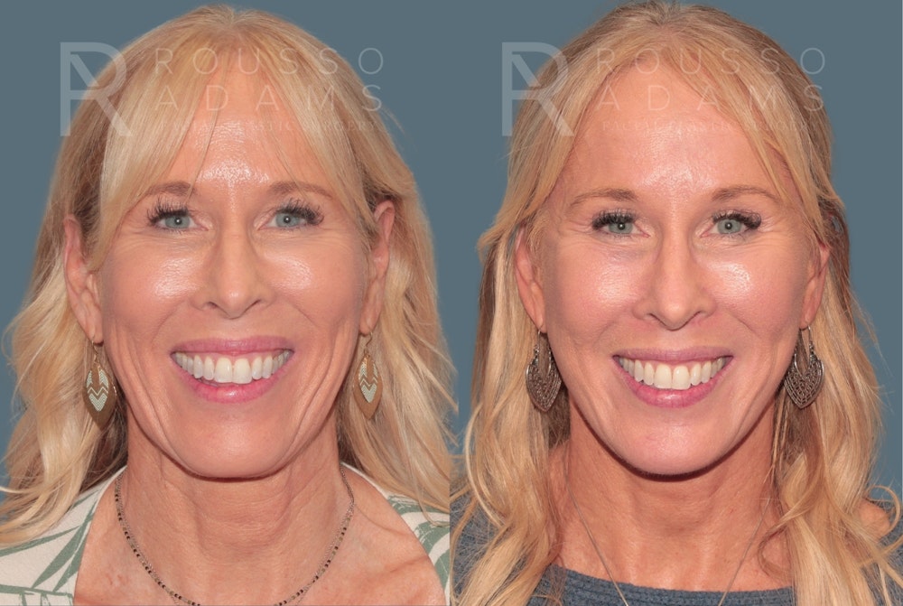 Deep Plane Facelift <span class=small>By Dr. Austin Adams</span> Before & After Gallery - Patient 388371 - Image 3