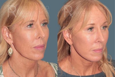 Deep Plane Facelift <span class=small>By Dr. Austin Adams</span> Before & After Gallery - Patient 388371 - Image 1