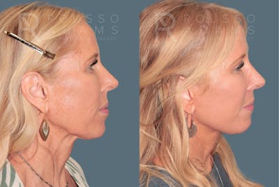 Deep Plane Facelift <span class=small>By Dr. Austin Adams</span> Before & After Gallery - Patient 388371 - Image 4