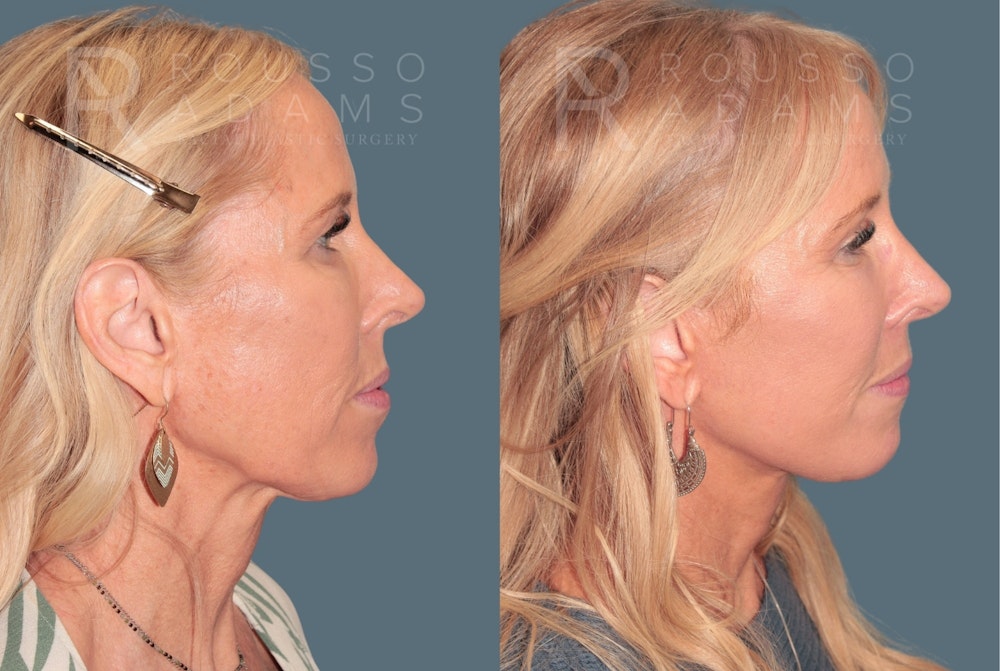 Deep Plane Facelift <span class=small>By Dr. Austin Adams</span> Before & After Gallery - Patient 388371 - Image 4