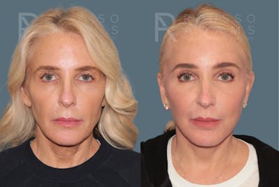 Deep Plane Facelift <span class=small>By Dr. Austin Adams</span> Before & After Gallery - Patient 358144 - Image 2
