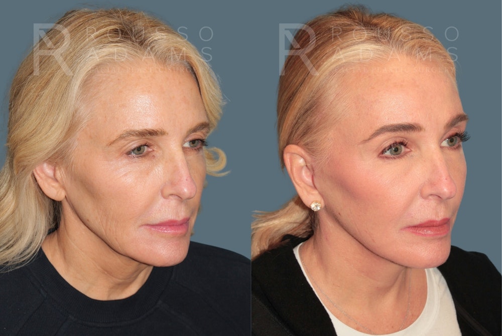 Deep Plane Facelift <span class=small>By Dr. Austin Adams</span> Before & After Gallery - Patient 358144 - Image 1