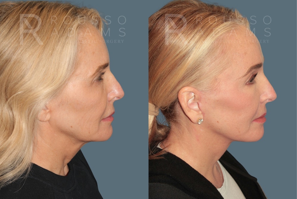 Deep Plane Facelift <span class=small>By Dr. Austin Adams</span> Before & After Gallery - Patient 358144 - Image 3