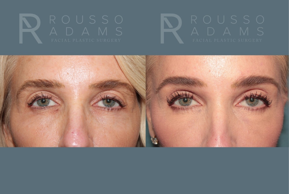 Blepharoplasty<span class=small>By Dr. Austin Adams</span> Before & After Gallery - Patient 274524 - Image 1
